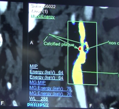 Spectral imaging of arteries