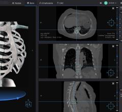 Infervision Introduces AI Capabilities for Chest CT Reading