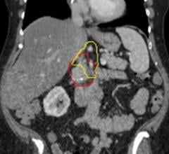 Johns Hopkins Pancreatic Cancer Study