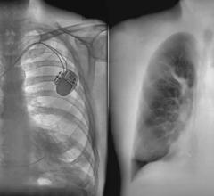 The KA X-ray technology gives doctors a clearer view of a patient's lungs by separating the bone structure (left) and soft tissue (right).
