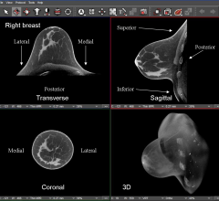 breast density, computed tomography