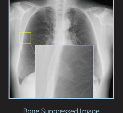Zwanger-Pesiri Radiology Implements Bone Suppression Imaging Technology to Enhance Chest X-rays