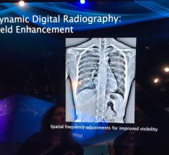 Dynamic Digital Radiography Used to Assess Undifferentiated Dyspnea