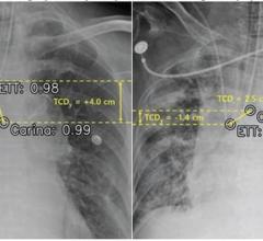 AI system by Lunit identified improperly positioned endotracheal tube on chest radiographs obtained after insertion, as well as on chest radiographs obtained from patients in the ICU at two institutions 