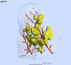 Three-dimensional segmentation of ginger-root shaped necrotic lesions (yellow) and surrounding vasculature (red) within a sample of Mycobacterium tuberculosis-infected human lung tissue (transparent surface). Africa Health Research Institute 