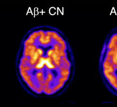 18F-SMBT-1 PET studies showed that beta-amyloid+ Alzheimer’s disease (AD) patients, but most importantly, beta-amyloid+ controls (CN) have significantly higher regional 18F-SMBT-1 binding than beta-amyloid- CN, with 18F-SMBT-1 retention highly associated with beta-amyloid burden. These findings suggest that increased 18F-SMBT-1 binding is detectable at the preclinical stages of beta-amyloid accumulation. 