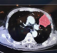 AI Detects Unsuspected Lung Cancer in Radiology Reports, Augments Clinical Follow-up