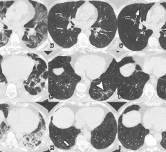 Serial non-contrast axial chest CTs of three study participants with prior COVID-19 pneumonia. 