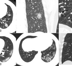 Chest CT images in a 34-year-old man with fever for 4 days. Positive result of reverse-transcription polymerase chain reaction assay for severe acute respiratory syndrome coronavirus 2 using a swab sample was obtained on February 8, 2020. Dates of examination are shown on images. A, Chest CT scan with magnification of lesions in coronal and sagittal planes shows a nodule with reversed halo sign in left lower lobe (box) at the early stage of the pneumonia. B, Chest CT scans in different axial planes and coro