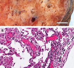 Lymphocytic Inflammation in a Lung from a Patient Who Died from Covid-19. The gross appearance of a lung from a patient who died from coronavirus disease 2019 (Covid-19) is shown in Panel A (the scale bar corresponds to 1 cm). The histopathological examination, shown in Panel B, revealed interstitial and perivascular predominantly lymphocytic pneumonia with multifocal endothelialitis (hematoxylin–eosin staining; the scale bar corresponds to 200 μm).