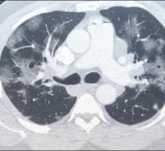 An example of a COVID-19 pneumonia of a chest CT scan. The COVID appears as white ground glass opacities (GGOs) in the lungs. Normal lungs on CT should appear black.