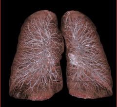 MD Anderson Study Early-stage Lung Cancer