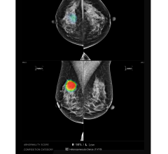 Collaborative study with the University of Nottingham Published in Radiology Highlights Potential of AI in Breast Cancer Detection