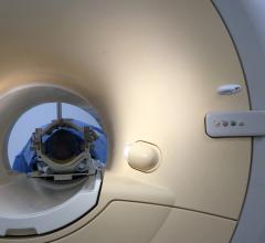 Delta T1 Maps Provide Quantitative, Automated Solution to Assess Brain Tumor Burden