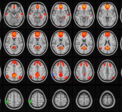 Figure 1. MRI images of the brain, with the default mode network (DMN) highlighted in orange/red. The DMN is active during periods of wakeful rest, when the mind is not focused on a particular task. The green and blue arrows point to areas of the network that are disrupted in adolescent patients with concussions.
