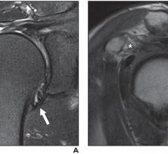 Two magnetic resonance imaging (MRI) findings — joint capsule edema and thickness at the axillary recess, specifically — proved useful in predicting stiff shoulder in patients with rotator cuff tears, according to an ahead-of-print article in the May issue of the American Journal of Roentgenology (AJR)