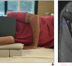 According to a pilot study published in ARRS’ American Journal of Roentgenology (AJR), the flexed elbow valgus external rotation (FEVER) view can improve magnetic resonance imaging (MRI) evaluation of the ulnar collateral ligament (UCL) in Major League Baseball (#MLB) pitchers.