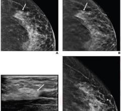 57-Year-Old Woman Presented for Screening Mammography: Digital, A, and tomosynthesis, B, craniocaudal images showed 1.8 cm asymmetry (arrows) lateral left breast categorized as BI-RADS 0. C, Ultrasound left breast evaluation revealed normal fibroglandular tissue (arrow) believed to correlate with mammographic finding. D, Asymmetry effaced on rolled lateral craniocaudal imaging. Metallic BB marker noted at 12 o’clock position, anterior depth. Final assessment BI-RADS 1. Image courtesy of ARRS