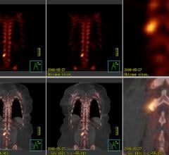Nuclear imaging of the spine shown on Philips Healthcare BrightView XCT