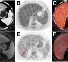 Indeterminate lesion on PET/CT classified by PET/MRI for 53-y-old man with lung cancer. 