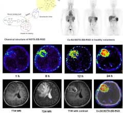 Representative maximum-intensity projection PET images of a healthy human volunteer injected with 64Cu-NOTA-EB-RGD at 1, 8, and 24 hours after injection. Axial MRI and PET slices of glioblastoma patient injected with 64Cu-NOTA-EB-RGD at different time points after injection. Image courtesy of Jingjing Zhang et al., Peking Union Medical College Hospital, Beijing, China/ Xiaoyuan Chen et al., Laboratory of Molecular Imaging and Nanomedicine, NIBIB/NIH, Bethesda, USA