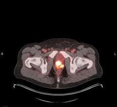 POSLUMA (flotufolastat F 18) PET/CT image showing uptake in the prostate gland, consistent with primary prostate cancer Photo courtesy of Blue Earth Diagnostics 