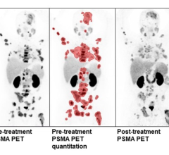 Quantitative analysis of pre-treatment PSMA PET/CT in a patient undergoing treatment with ¹⁷⁷Lutetium-PSMA-617/NOX66. Post-treatment PSMA PET/CT demonstrates reduced tumor volume and PSMA intensity. Images created by S Pathmanandavel and L Emmett, St Vincent's Hospital, Sydney, Australia.