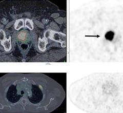 PSMA PET/CT accurately detects recurrent prostate cancer in 67-year-old man. 18F-DCFPyL-PSMA PET/CT shows extensive, intensely PSMA-avid local recurrence in prostate (bottom row; solid arrow) in keeping with the known tumor recurrence in the prostate. Right: PET shows extensive, intensely PSMA-avid local recurrence in prostate (top row; solid arrow) and a solitary bone metastasis in left rib 2 (bottom row; dotted arrow). Image courtesy of Ur Metser, et al.