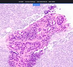 Paige Lymph Node detects the presence of breast cancer metastases with near-perfect sensitivity with the power of AI