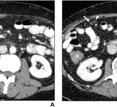 66-Year-Old Man With Locally Advanced Pancreatic Cancer Undergoing Chemotherapy