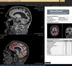 Delaware Imaging Network Now Offers NeuroQuant Brain Imaging MRI Software
