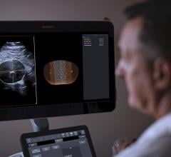 The Philips AAA Model integrates software and Philips 3-D ultrasound technologies into a single solution to automatically segment and quantify the size of the aneurysm sac for surveillance of known native and post-EVAR treated AAAs.