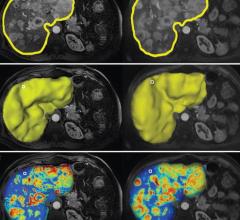 Liver cancer advanced imaging. Webinar will cover new advances for more precise targeting of Liver Cancer.