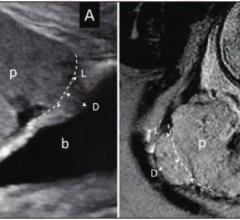 A) Ultrasound in 28-year-old woman (B) MRI in 34-year-old woman with suspected PAS disorder. Focal area of placental tissues bulge toward imaginary lines of normal uterine contour (dash lines). Length (L) and depth (D) measurements of placental bulge also demonstrated. p = placenta; b = bladder. Image courtesy of American Roentgen Ray Society (ARRS), American Journal of Roentgenology (AJR)