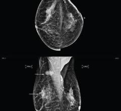 artificial intelligence-based computer-aided detection (AI-CAD) can be a practical addition for lowering false-positive findings when performing post-breast conserving therapy (BCT) surveillance mammography