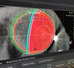 Proton therapy for the eye treatment plan shown by RaySearch at AAPM 2019. #AAPM2019 #AAPM