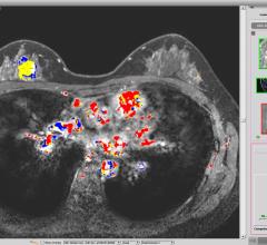 Paragon Biosciences Launches Qlarity Imaging to Advance FDA-cleared AI Breast Cancer Diagnosis System