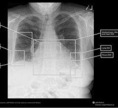 chest, x-ray, FDA, lung, Qure.ai