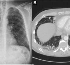 Images in a 44-year-old man who presented with chest pain and dyspnea. (A) Chest X-ray shows very subtle nodular opacities, primarily in lower lobes, representative of pneumonia and a discrete silhouette sign of the right cardiac border (arrow). The AI system interpreted this chest X-ray as normal. It was also interpreted as normal in the clinical radiology report. (B) CT scan shows the lower lobe airspace opacities with vague tree-in-bud morphology (box) and an area of consolidation (arrow). Pulmonary angi