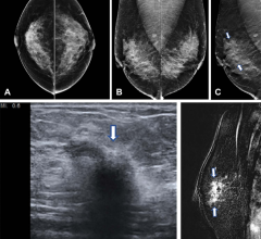 In a study of over a million women, digital breast tomosynthesis (DBT) showed improved breast cancer screening outcomes over screening with standard digital mammography alone. The results of the study were published in Radiology, a journal of the Radiological Society of North America (RSNA) 