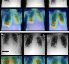 A new artificial intelligence (AI) model combines imaging information with clinical patient data to improve diagnostic performance on chest X-rays