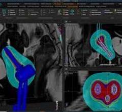  The latest versions of RayStation (11A) and RayCare (5A) were released in May 2021. A new feature in the RayStation release is dose planning for Accuray’s CyberKnife system for radiosurgery and stereotactic body radiation therapy (SBRT). 