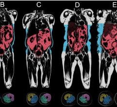 The collection of whole-body repeat imaging scans of 60,000 UK Biobank participants will provide researchers with a unique set of longitudinal measures to understand the determinants and progression of disease in mid-to-later life. 
