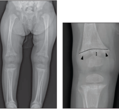 rickets and classic metaphyseal lesions (CMLs) exhibit distinct radiographic signs, and radiologists can reliably differentiate these two entities 