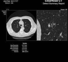 ClearRead CT with CVI Improves Chest Nodule Detection 