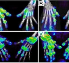 PET/CT tracer, rheumatoid arthritis, SNMMI