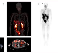 During its 2023 Annual Meeting, the Image of the Year was selected by the Society of Nuclear Medicine and Molecular Imaging (SNMMI), and represents research presented which reports on the ability of a novel theranostic pair to successfully detect metastatic pancreatic cancer and provide a means of selecting appropriate treatments.