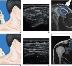 (A) Patient lies in supine and neutral position, gently stretches neck muscle, and turns head slightly to contralateral side. Transducer is initially placed with application of minimal pressure. (B) Supraspinatus and trapezius muscles identified in transverse plane. (C) Representation of view using sagittal T2-weighted MR image. (D) Transducer turned to longitudinal view. (E) Supraspinatus and trapezius muscles visualized along longitudinal orientation of muscle fibers. (F) Representation of view using coro