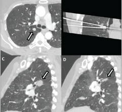 (A) Pre-procedure axial image from contrast-enhanced CT scan of chest demonstrates a 1 cm solid right upper lobe nodule adjacent to right mainstem bronchus (arrow). (B) Intra-procedural coronal reformatted image shows two cryoablation probes within nodule. (C) 1-month follow-up sagittal chest CT image shows expected post-ablation changes encompassing treated nodule (arrow). (D) 1-year follow-up sagittal chest CT image shows expected involution of treatment zone into flat bandlike scar without residual tumor