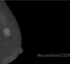 #RSNA19 GE Healthcare introduced Serena Bright, the healthcare industry’s first contrast-enhanced mammography solution for biopsy